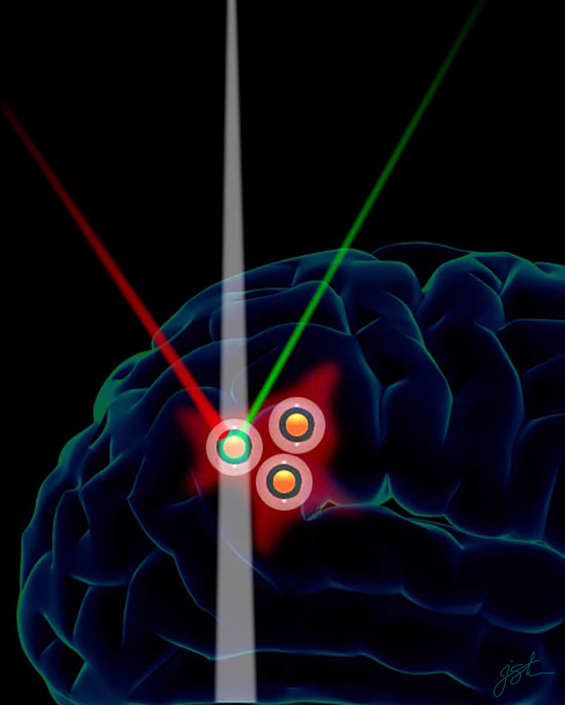 Illustration for a triple-modality MRI-photoacoustic-Raman nanoparticle